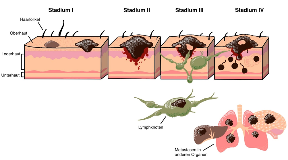Haut Lymphknoten in verschiedenen Stadien